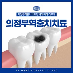 의정부역충치치료