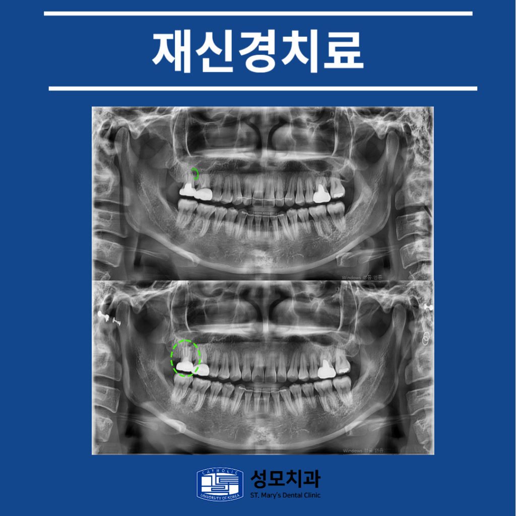 의정부신경치료