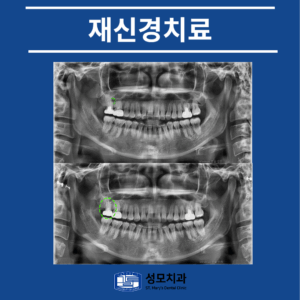 의정부신경치료