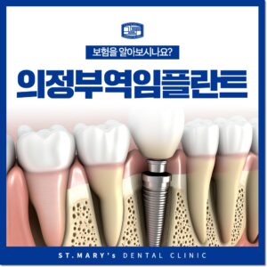 의정부역임플란트